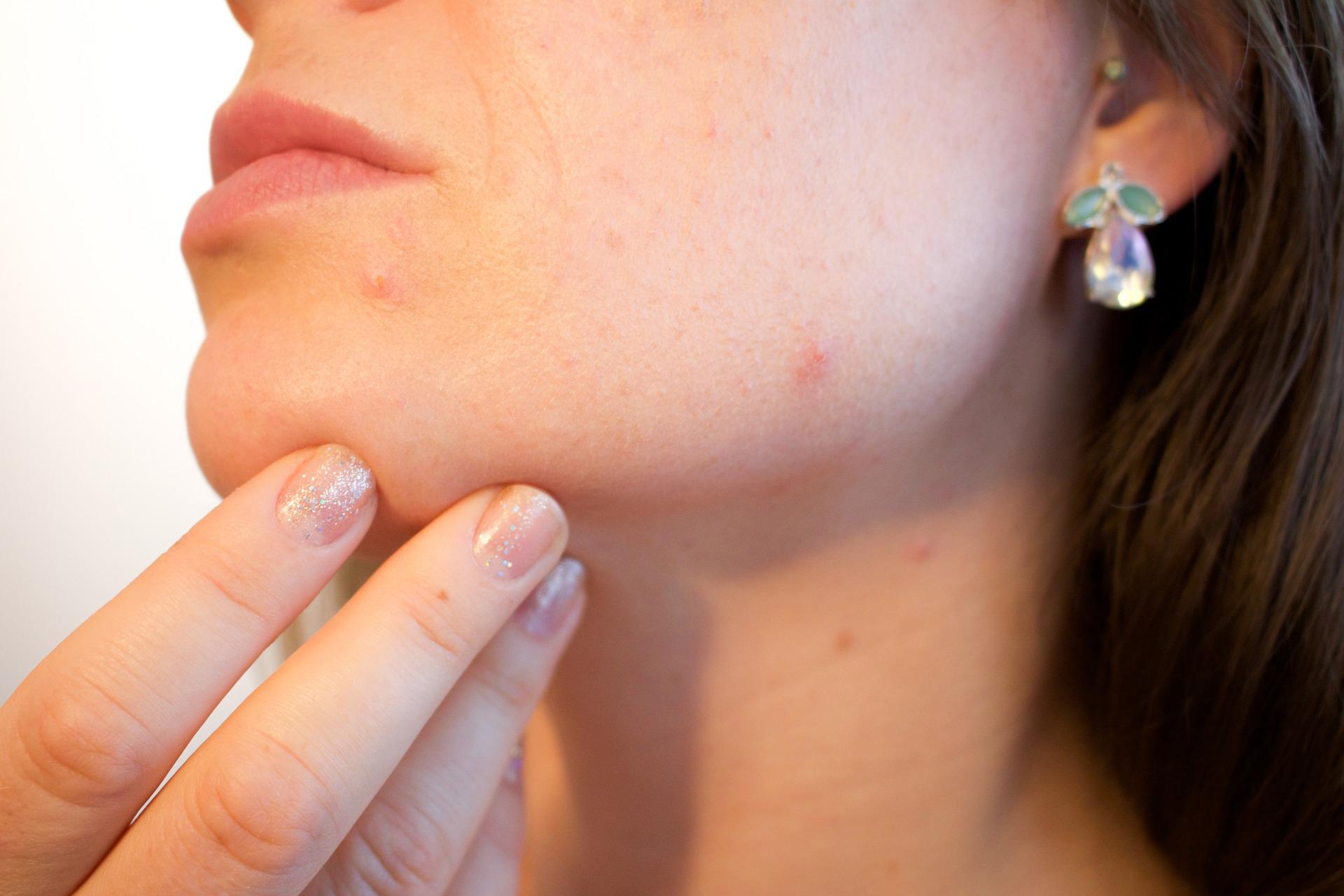 acne-ge297aa701_1920